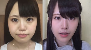 脂肪吸引前後の轟ちゃん