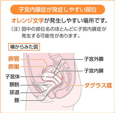 子宮内膜症が発症しやすい部位